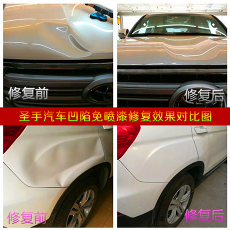 凹陷修复案例